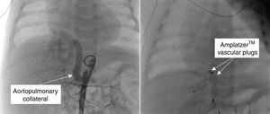 Angiography in the descending aorta showing a patent serpentine collateral artery originating in the abdominal aorta (left) and transcatheter embolization with two 8-mm AmplatzerTM vascular plugs (right).