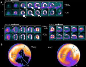 Example of assessment of myocardial viability with positron emission tomography imaging. (A) Top rows: 13N-labeled ammonia (13NH3) is used as a tracer of myocardial blood flow at rest in short-axis images starting at the apex and moving toward the base of the heart (upper image), horizontal long axis (lower left) and vertical long axis (lower right). Myocardial perfusion is markedly decreased in the apical, inferior and inferolateral regions (white arrows); Bottom rows: 18F-2-fluoro-2-deoxyglucose (FDG) is used as a tracer of myocardial glucose metabolism. FDG uptake is enhanced relative to blood flow, demonstrating a pattern of perfusion-metabolism mismatch (white arrows) in the abnormally perfused myocardial regions, indicative of viable or hibernating myocardium; (B) polar map of viability study. The left polar map plot displays the extent of the rest perfusion defect (black area); the right polar map plot shows FDG uptake in the rest perfusion defect area indicating metabolic viability. Image source: Instituto das Ciências Nucleares Aplicadas à Saúde (ICNAS).