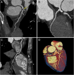 Coronary computed tomography angiography images. Curved multiplanar reformats of the left anterior descending artery (LAD) (A), left circumflex artery (B) and right coronary artery (C); three-dimensional volume rendering image of the heart (D). Note the presence of significant stenosis in the proximal LAD due to non-calcified plaque (arrows).