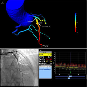 Correlation between invasive coronary angiography and coronary computed tomography (CT) angiography. (A) CT-derived fractional flow reserve (FFR) imaging showing an intermediate stenosis in the proximal left anterior descending artery (LAD) with a computed FFR of 0.75; (B) invasive coronary angiography confirming a 75% stenosis in the proximal LAD; (C) the measured value of invasive FFR was 0.76, which showed a good agreement with the CT-derived value (A).