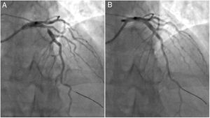 Images from invasive coronary angiography before (A) and after (B) percutaneous coronary intervention in the proximal left anterior descending artery, with successful implantation of a drug-eluting stent.
