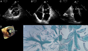 (A-C) Short-axis, apical 4- and 2-chamber transthoracic echocardiographic images, respectively, showing a round mass inside the left ventricle, attached to the papillary muscle (arrow); (D) three-dimensional echocardiographic short-axis view using the 2-Click Crop function from the apex; (E and F) histopathology; (E) neoform of papillary architecture (Masson's trichrome, 25×); (F) papillary axes consisting of collagen, stained green, and lax stroma with endothelial/endocardial coating (Masson's trichrome, 100×).