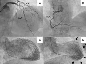 (A) Cranial projection showing left anterior descending (LAD) and circumflex (CX) arteries without significant lesions; (B) cranial projection showing right coronary artery (RCA) without significant lesions; (C) ventriculography with left ventricle in end-diastole; (D) ventriculography showing left ventricle in end-systole, with apical akinesia (arrows).