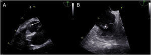 Transesophageal echocardiogram: small mobile vegetation in the non-coronary sinus of Valsalva (A: arrow) and on the tricuspid valve (B: asterisk).