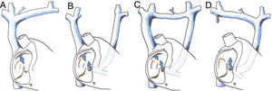 Diagram of superior vena cava anomalies. (A) Physiological right superior vena cava; (B) persistent left superior vena cava; (C) persistent left superior vena cava with an anterior communicating vein; (D) persistent left superior vena cava and absent right superior vena cava. Blue arrow: intake of deoxygenated blood from upper part of the body into the right atrium.