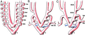 Diagram of the embryonic development of a double-lumen aorta with a persistent fifth aortic arch, with progression from A to C. 1st: first aortic arch; 2nd: second aortic arch; 3rd: third aortic arch; 4th: fourth aortic arch; 5th: fifth aortic arch; 6th: sixth aortic arch; 7th IA: seventh intersegmental artery; BCT: brachiocephalic trunk; CCA: common carotid artery; ECA: external carotid artery; ICA: internal carotid artery; SA: subclavian artery; VA: vertebral artery.
