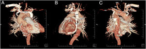 Three-dimensional computed tomography reconstruction of persistent left superior vena cava (A and B) and persistent fifth aortic arch (C). 4th: fourth aortic arch; 5th: fifth aortic arch; AV: azygos vein; BCT: brachiocephalic trunk; HAV: hemizygos vein; LCCA: left common carotid artery; LSA: left subclavian artery; LSVC: left superior vena cava; LVA: left vertebral artery; RBCV: right brachiocephalic vein.