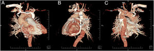 Three-dimensional computed tomography reconstruction of persistent left superior vena cava (A and B) and persistent fifth aortic arch (C). 4th: fourth aortic arch; 5th: fifth aortic arch; AV: azygos vein; BCT: brachiocephalic trunk; HAV: hemizygos vein; LCCA: left common carotid artery; LSA: left subclavian artery; LSVC: left superior vena cava; LVA: left vertebral artery; RBCV: right brachiocephalic vein.