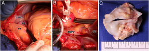 Perioperative photograph of persistent left superior vena cava (A), absent right superior vena cava (B) and excised unicommissural unicuspid stenotic aortic valve (C). A: aorta; LA: left atrium; LSVC: left superior vena cava; PT: pulmonary trunk; RSPV: right superior pulmonary vein with the inserted venous cannula; VC: venous cannula of cardiopulmonary bypass inserted through the right atrium into the right atrium.