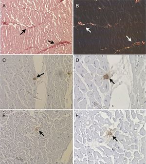 Histological section of a fragment of left ventricle examined (A) under visible light (arrows) (picrosirius stain, 200×) and (B) under polarized light, which reveals birefringent collagen fibers (arrows) (picrosirius stain, 200×); (C and D) mast cells (arrows) immunolabeled with anti-chymase antibodies (immunohistochemistry, 200×and 400×); (E and F) mast cells (arrows) immunolabeled with anti-tryptase antibodies (immunohistochemistry, 200×and 400×).