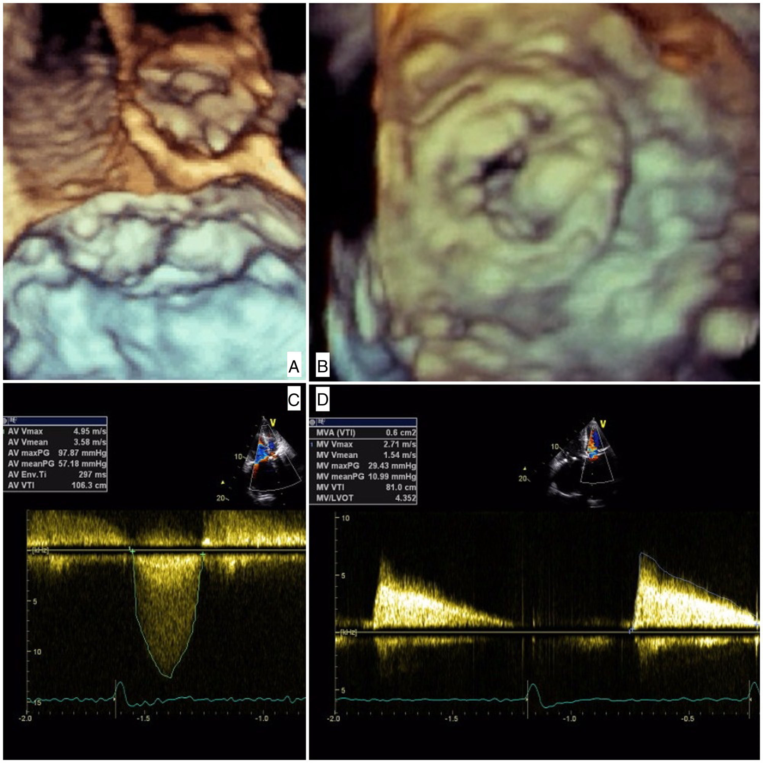 Innovative transapical-transfemoral loop approach: First case of ...
