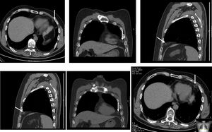 Thoracic computed tomography in July 2017, showing further reduction in the size of the paracardiac lesion (arrows).