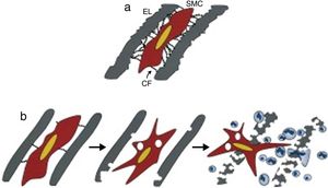 (a) Mecanismo de ligação da célula muscular lisa às lâminas elásticas circundantes por intermédio de filamentos de conexão compostos por fibrilina‐1. (b) Modelo de elastólise na síndrome de Marfan, mostrando que o défice de filamentos de fibrilina‐1 origina uma alteração no programa sintético da célula muscular lisa que contribui para uma elastólise precoce, à qual se associa uma infiltração de células inflamatórias na túnica média do vaso sanguíneo precipitando o seu colapso estrutural. Adaptado de Phenotypic Alteration of Vascular Smooth Muscle Cells Precedes Elastolysis in a Mouse Model of Marfan Syndrome, Bunton TE, Biery NJ, Myers L, et al., Circ Res, 88:37‐43, 2001. CF, filamento de conexão; EL, lâmina elástica; SMC, célula muscular lisa.