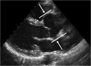 Imagem de ecocardiograma, em plano de paraesternal longo‐eixo, em doente com Marfan, observando‐se dilatação da raiz da aorta (traços) e seios de Valsalva (setas).