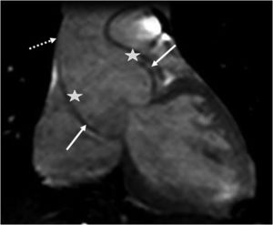 Imagem estática de cine‐ressonância magnética em portador de Marfan, revelando dilatação da raiz da aorta (setas a cheio), apagamento da junção sino‐tubular (estrelas) e dilatação da aorta ascendente proximal (seta a tracejado).