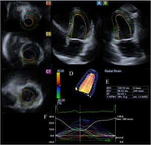 Three-dimensional speckle-tracking echocardiographic study of an acromegalic patient. Apical 4-chamber view (A) and apical 2-chamber view (B) are automatically selected by the software. Cross-sectional planes are at the apical (C3), midventricular (C5) and basal (C7) left ventricular (LV) levels. The three-dimensional LV model (D) and the corresponding volumetric parameters (E) are shown along with segmental LV radial strain curves (F).
