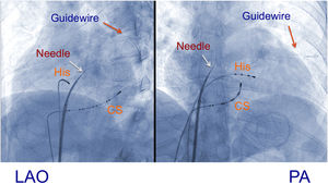 Left anterior oblique (LAO) and posteroanterior (PA) views in which catheters are displayed as anatomical references, with a decapolar catheter in the coronary sinus (CS) and a quadripolar catheter in the bundle of His (His); an 8F SL0 transseptal sheath and dilator (St. Jude Medical) and standard Brockenbrough needle (BRK XS, St. Jude Medical) with deployment of a Runthrough floppy guidewire through the Brockenbrough needle.