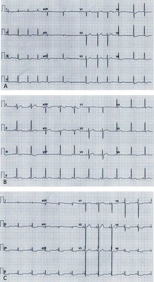 Electrocardiograms: (A, Case 1): atrial fibrillation, ST-segment depression and biphasic T-waves in V4-V6, III and aVF; (B, Case 2): sinus rhythm, short PR interval, T-wave inversion in III, flat T-wave in aVF, biphasic T-wave in II, V4-V6; (C, Case 3): sinus rhythm, short PR interval, electrocardiographic criteria for left ventricular hypertrophy, ST-segment depression and T-wave inversion in V4-V6, II, III and aVF.
