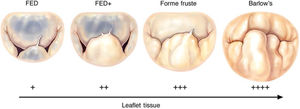 The spectrum of degenerative mitral valve disease, as proposed by Carpentier (Adams DH et al. Eur Heart J 2010;31:1958-1966).