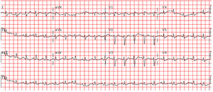 Eletrocardiograma na admissão no Serviço de Urgência demonstra taquicardia sinusal, desvio direito do eixo, bloqueio incompleto do ramo direito e inversão das ondas T na derivação III.