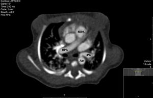 Axial view computed tomography angiography showing the left pulmonary artery branch arising from the descending aorta. Ao: aorta; LPA: left pulmonary artery; MPA: main pulmonary artery; RPA: right pulmonary artery.