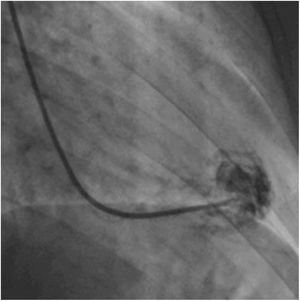 Contrast injection into the left ventricle after guide catheter placement.