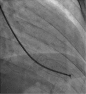Bioptome deployment with open forceps, immediately before sampling.