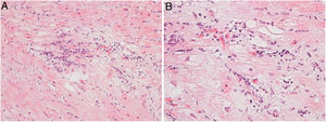 (A) Focal lymphocytic myocarditis. Slight edema and a prominent lymphocytic infiltrate are present in the interstitium. Absence of fibrosis (hematoxylin and eosin). (B) Interstitial lymphocytic infiltration and myocyte damage in the form of apoptosis are present (hematoxylin and eosin).
