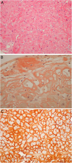 (A) Light-chain cardiac amyloidosis. Hyalin widening of the interstitial space in the myocardial tissue (hematoxylin and eosin). (B) Extracellular amyloid deposits in the endocardium and surrounding the cardiomyocytes (Congo red staining). (C) Lambda light-chain immunostaining of the pericellular amyloid deposits (immunohistochemical method with an anti-lambda light-chain antibody).