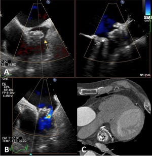 A: Transesophageal echocardiography (TEE) image showing anteroinferior leak (yellow arrow) and posterosuperior leak (white arrow). B: Transesophageal echocardiography with TEE image showing color flow Doppler through the posterosuperior leak. C: Computed tomography image showing leaks on both sides of the device.