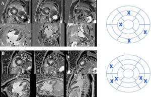 Cardiac magnetic resonance imaging of two patients with hypertrophic cardiomyopathy included in the study showing late gadolinium enhancement (LGE) and the respective bull