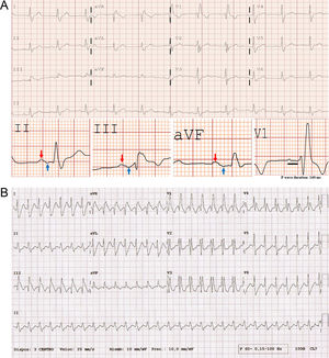 (A) Sinus rhythm at 66 bpm with a prolonged and +/- biphasic P wave in the inferior leads (red arrow: + component; blue arrow: - component), which meets the criteria of advanced interatrial block and a right bundle branch block. (B) Regular wide QRS complex tachycardia at 171 bpm. The absence of AV dissociation or precordial concordance, RS interval <100 ms and typical right bundle branch block morphology (identical to the baseline ECG) suggests a supraventricular origin. An adenosine test was performed, unmasking atrial flutter (not shown).