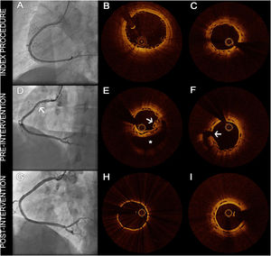 (A) Index right coronary angiography after angioplasty; (B) index optical coherence tomography (OCT) imaging after angioplasty; (C) index OCT imaging with residual proximal dissection covered by stent struts; (D) suspicious lesion, suggestive of a residual dissection/false aneurysm (arrow); (E) proximal BVS stents with a large hematoma (asterisk), overlapped struts and struts protruding into the lumen (arrow); (F) entry flaps of the residual proximal dissection (arrow); (G) final angiographic result after angioplasty; (H) final OCT showing correct stent expansion and sealing of the flaps; (I) six-month follow-up OCT with no signs of stent restenosis.