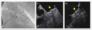 Fluoroscopy (A) and transesophageal echocardiogram (B and C) images showing correct Amplatzer Amulet device implantation in the left atrial appendage (arrows). CX indicates circumflex artery.
