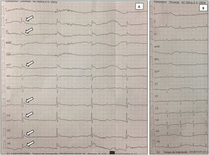 (A) Initial electrocardiogram: Osborn waves (arrows), complete atrioventricular block and tremor artifact; (B) electrocardiogram after patient warming: resolution of previous abnormalities.