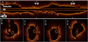 Post-lithotripsy intracoronary optical coherence tomography images showing deep, transverse fractures both in calcium arc and nodules (arrows).