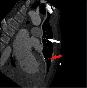 Coronary computed tomography angiography showing left internal mammary graft (white arrow) and site of anastomosis to the left anterior descending artery (red arrow).
