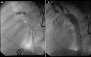 A: Lateral projection depicting the use of a Tyshak balloon for sizing of the residual ductus in a patient with a previous surgical ligation. B: An ADO II 3x4 mm device was successfully placed, with no residual shunt on the control aortogram. ADO: Amplatzer duct occluder.