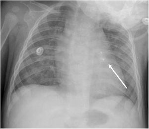 Chest radiograph (anteroposterior) revealing a migrated ADO II AS device (arrow) into a branch of the left pulmonary artery. ADO: Amplatzer duct occluder; AS: additional sizes.