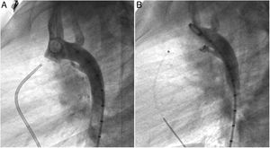 Pre (A) and post-closure (B) lateral aortography depicting a patent ductus arteriosus occlusion with a 4x4 mm Nit-Occlud coil.