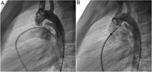 Pre (A) and post-closure (B) lateral aortography depicting a patent ductus arteriosus occlusion with a 6x4 mm ADO I device. ADO: Amplatzer duct occluder.