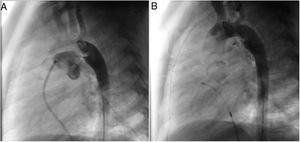Pre (A) and post-closure (B) lateral aortography depicting a patent ductus arteriosus occlusion with a 3x6 mm ADO II device. ADO: Amplatzer duct occluder.