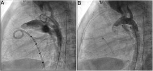 Pre (A) and post-closure (B) lateral aortography depicting a patent ductus arteriosus occlusion with a 5x6 mm ADO II AS device. ADO: Amplatzer duct occluder; AS: additional sizes.