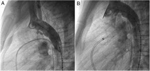 Pre (A) and post-closure (B) lateral aortography depicting patent ductus arteriosus occlusion with a 6 mm AVP II device. AVP: Amplatzer vascular plug.