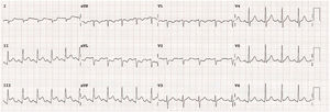 Electrocardiogram during dobutamine 30 mcg/kg/min. ST-segment elevation in inferior leads (II, III and aVF) and ST depression in I and aVL leads suggesting inferoposterior wall ischemia.