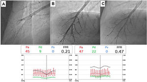 Pressure-wire-guided balloon plastic angioplasty of right medium lobe A5 segment, measuring distal pressure using a microcatheter-based manometer (Navvus rapid exchange FFR micro-Catheter, Acist, Eden Prairie, Minnesota, USA). This was the first session of a severe chronic thromboembolic pulmonary hypertension patient with systolic pulmonary artery pressure (PAP) around 80mmHg and mean PAP 40 to 50 mmHg. A) Subocclusion of two A5 subsegments in selective angiography. Intravascular hemodynamics (bottom left) revealed a significantly dampened distal pressure waveform (green line) and resting Pd/Pa=0.21; B) Improved angiographic appearance of one A5 subsegment after successive dilation with 2.0-mm and 3.0-mm balloons. Intravascular hemodynamics (bottom right) revealed improved distal pressure waveform with a Pd value of 22mmHg (green line); C) Final angiographic result with improved vessel perfusion in both subsegments.
