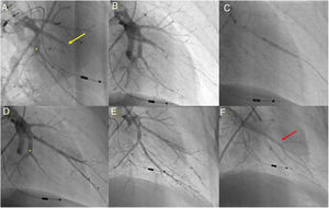 Angioplastia pulmonar com balão do segmento A7+8 do lobo inferior esquerdo. A) Angiografia pulmonar seletiva demonstrando oclusão total do segmento A8 (seta amarela) e web na bifurcação do segmento A7 (*); B) Passagem de fio guia Whisper MS (Abbot Vascular, Santa Clara, CA, USA), através da oclusão do segmento A8; C) Dilatação do vaso com balão semicomplacente Pantera Pro (Biotronik SE & Co KG, Berlin, Germany) 4.0/20mm; D) Angiografia pulmonar seletiva demonstrando um bom resultado final no nível do segmento A8 e segmento A7 ainda não abordado (*); E) Após dilatação do segmento A7 no nível da web (*) verifica‐se bom resultado angiográfico final com aumento do fluxo arterial; F) Retorno venoso presente (seta vermelha) na angiografia seletiva final do segmento A7+8 a documentar fluxo pulmonar grau 3.
