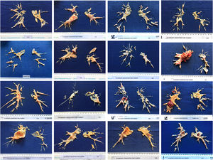 Amostras de espécimes de tromboendarterectomia pulmonar.