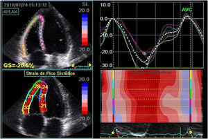 Análise do strain longitudinal global do ventrículo direito pela 2DSTE. Strain longitudinal global do ventrículo direito, obtido pela média do strain dos três segmentos da parede livre do ventrículo direito em paciente com diabetes mellitus tipo 1. Neste caso, estimado em ‐30,6%. Observação: o valor demonstrado na ﬁgura considerou os segmentos da parede septal para cálculo do strain.