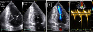 Transthoracic echocardiogram after detraining. Note the abnormal shape of the left ventricular cavity (small cavity size, prominent papillary muscle, with apical cavity obliteration in systole (A) and increased flow velocity (arrow) (B) suggestive of a myopathic left ventricle, rather than adaptive remodeling following training. LA: left atrium; LV: left ventricle; RA: right atrium; RV: right ventricle.